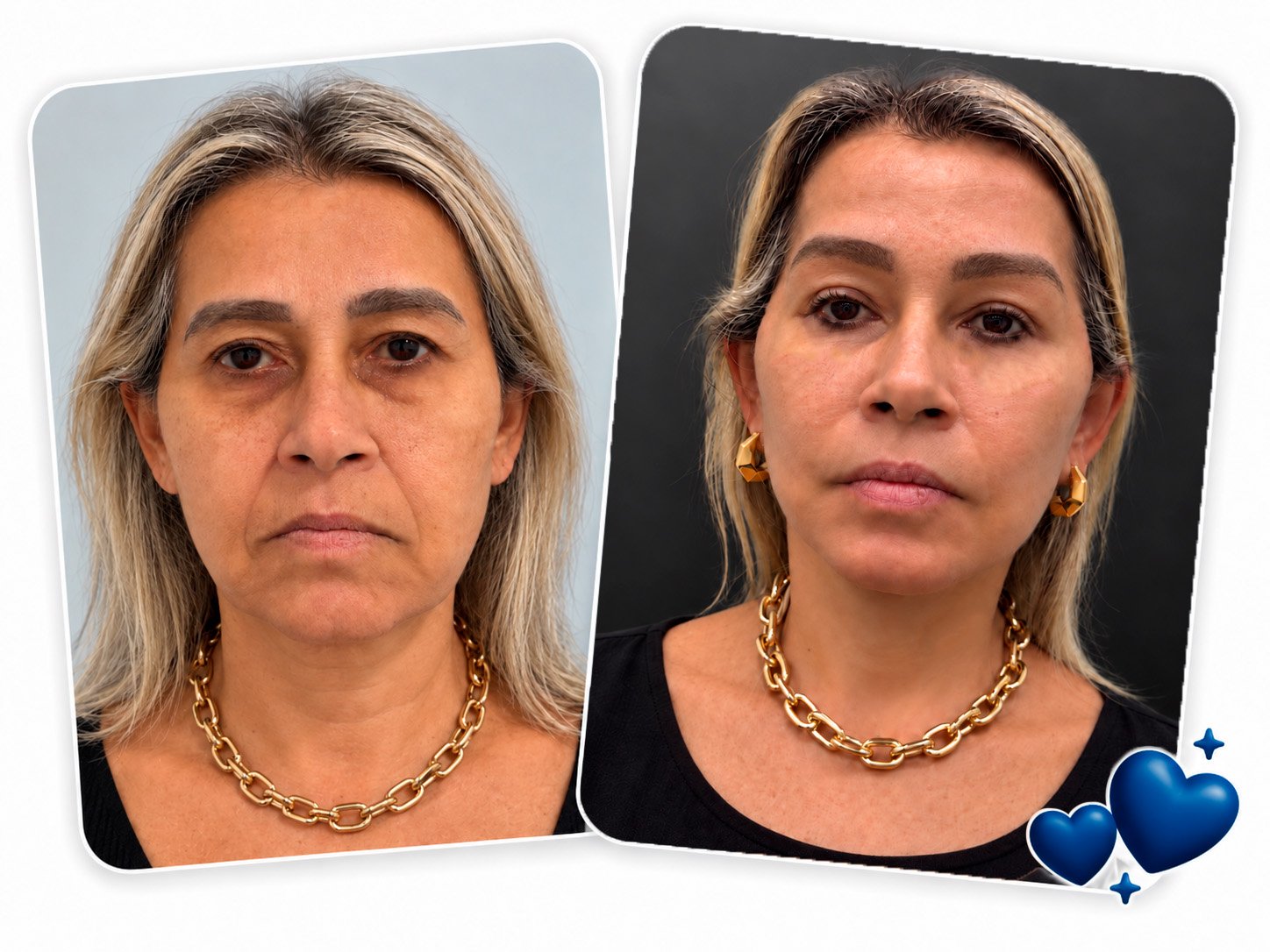 Antes e Depois